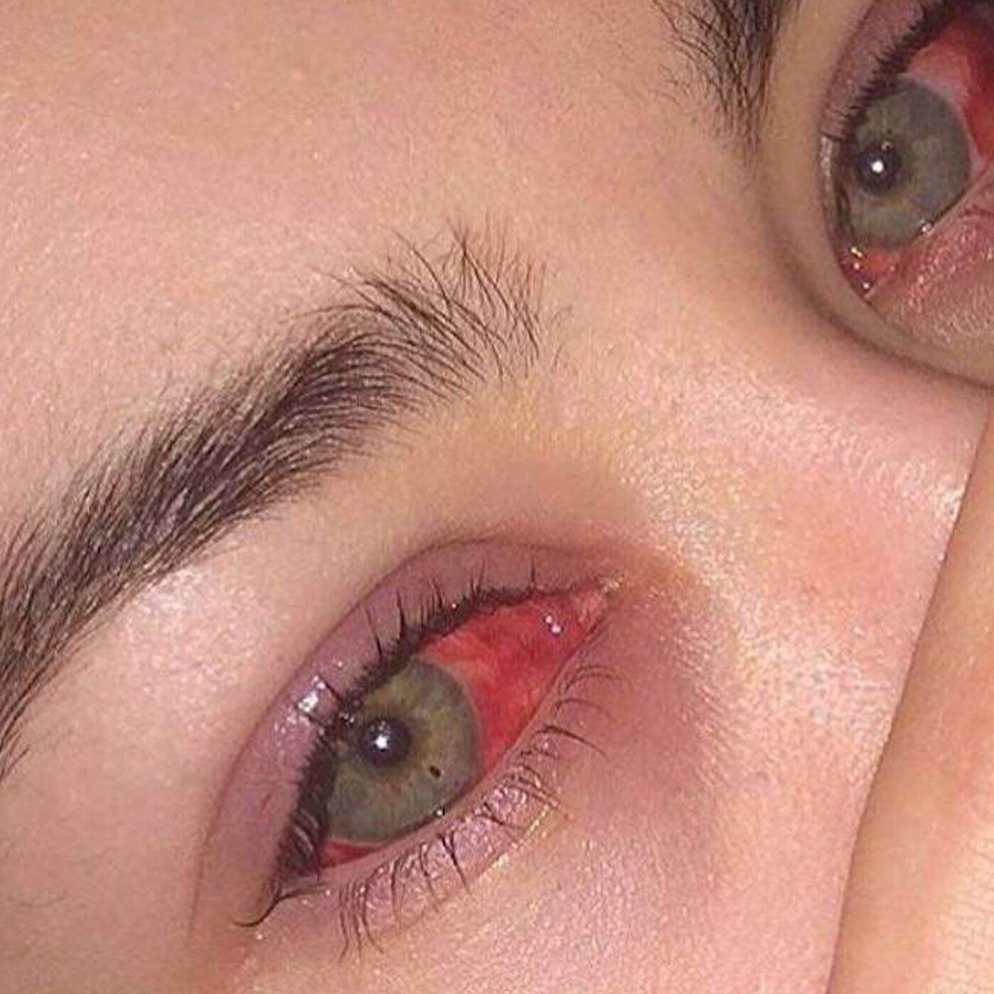 Scharlach Rote Augen
