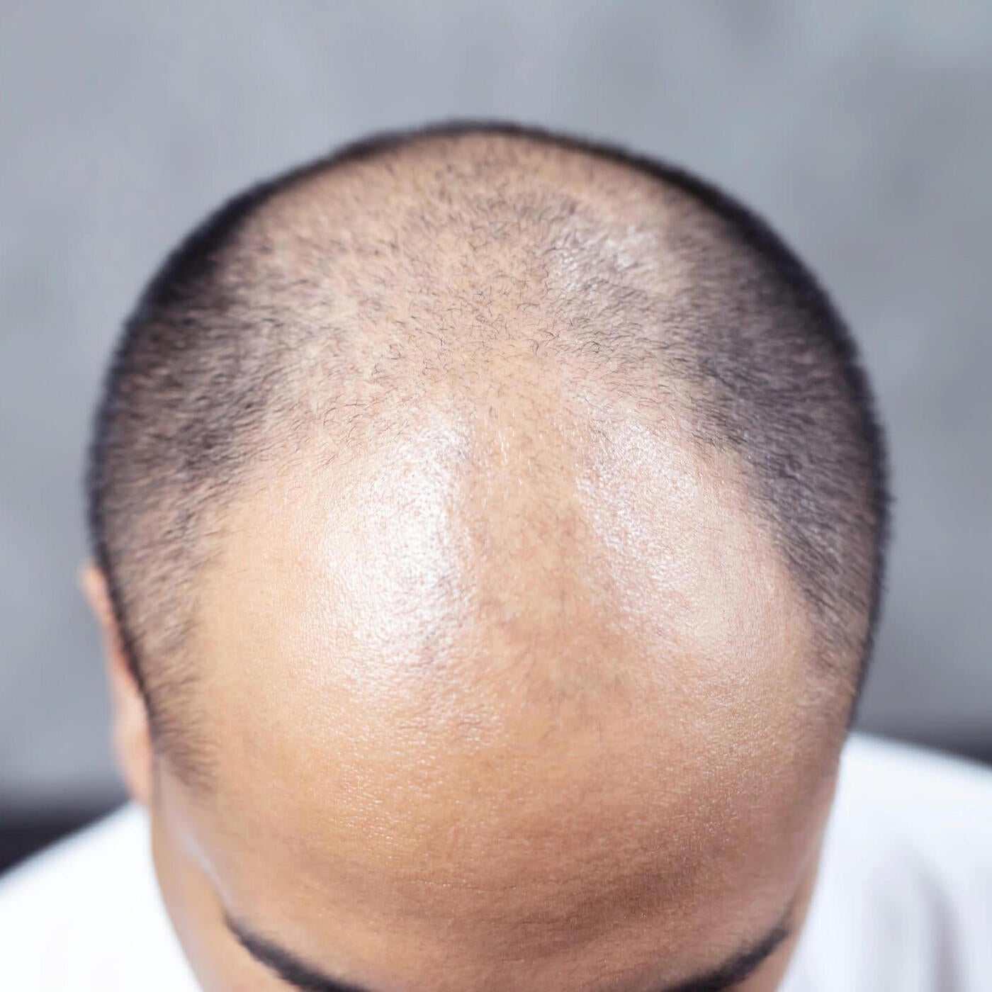 Alopecia