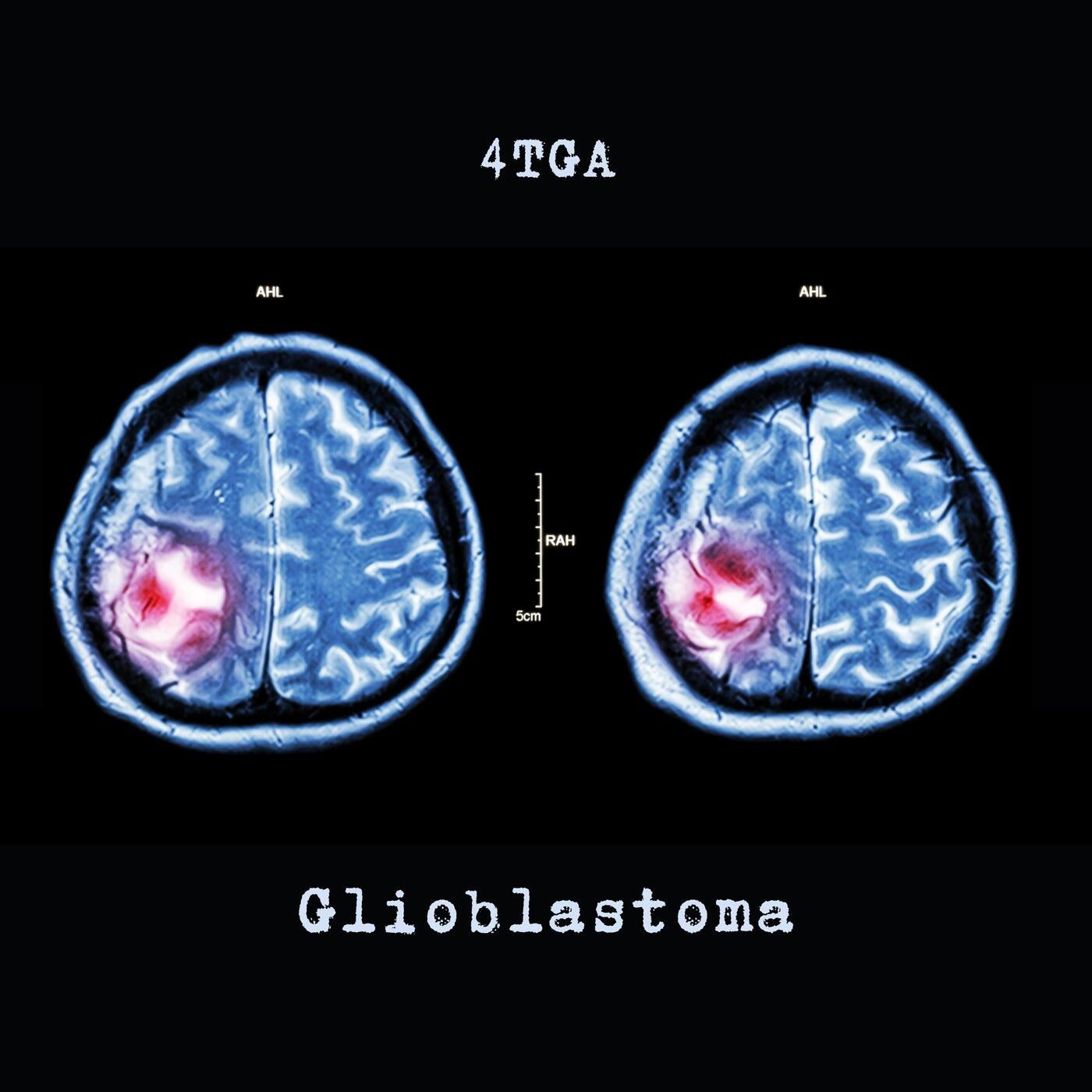 Glioblastoma