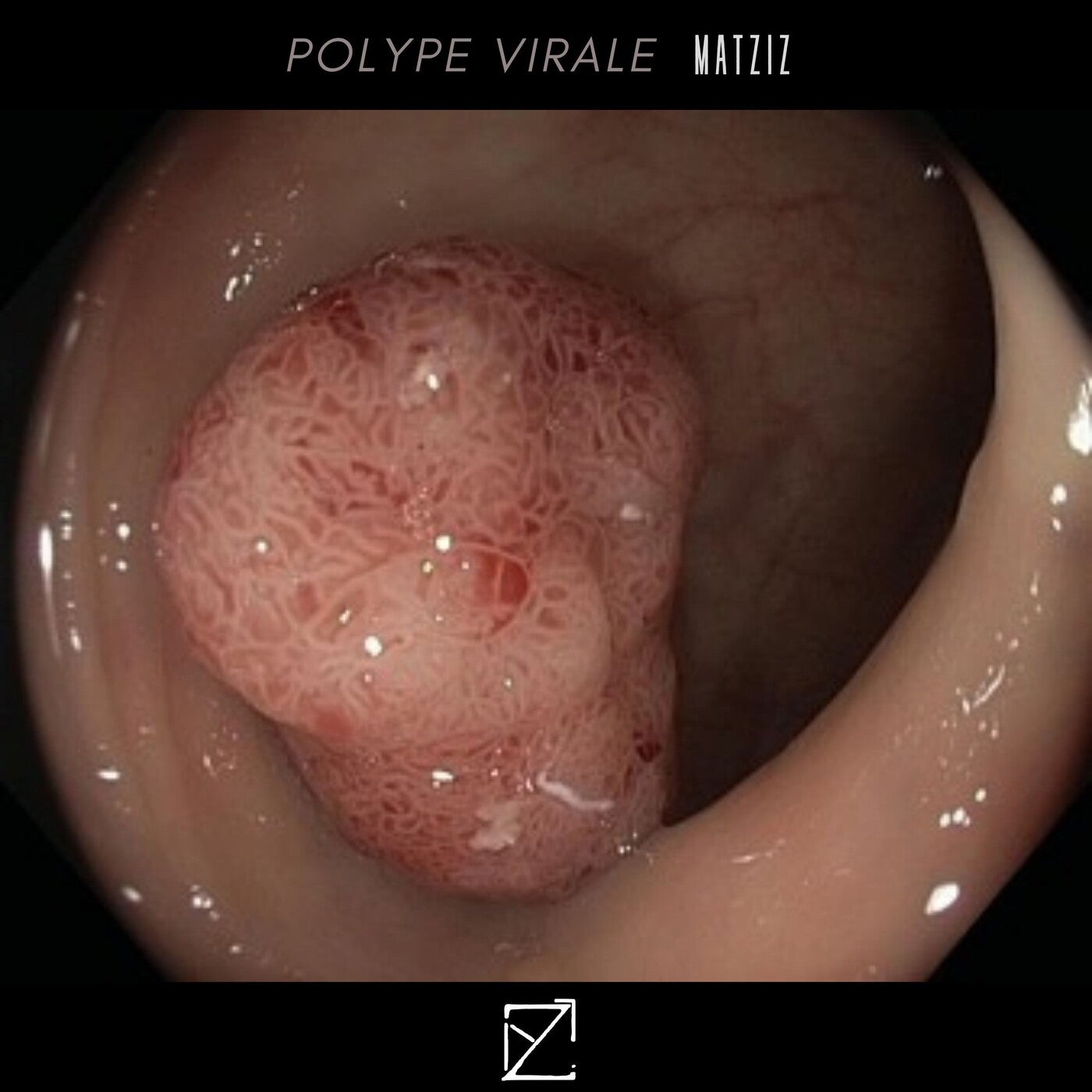 Polype Virale