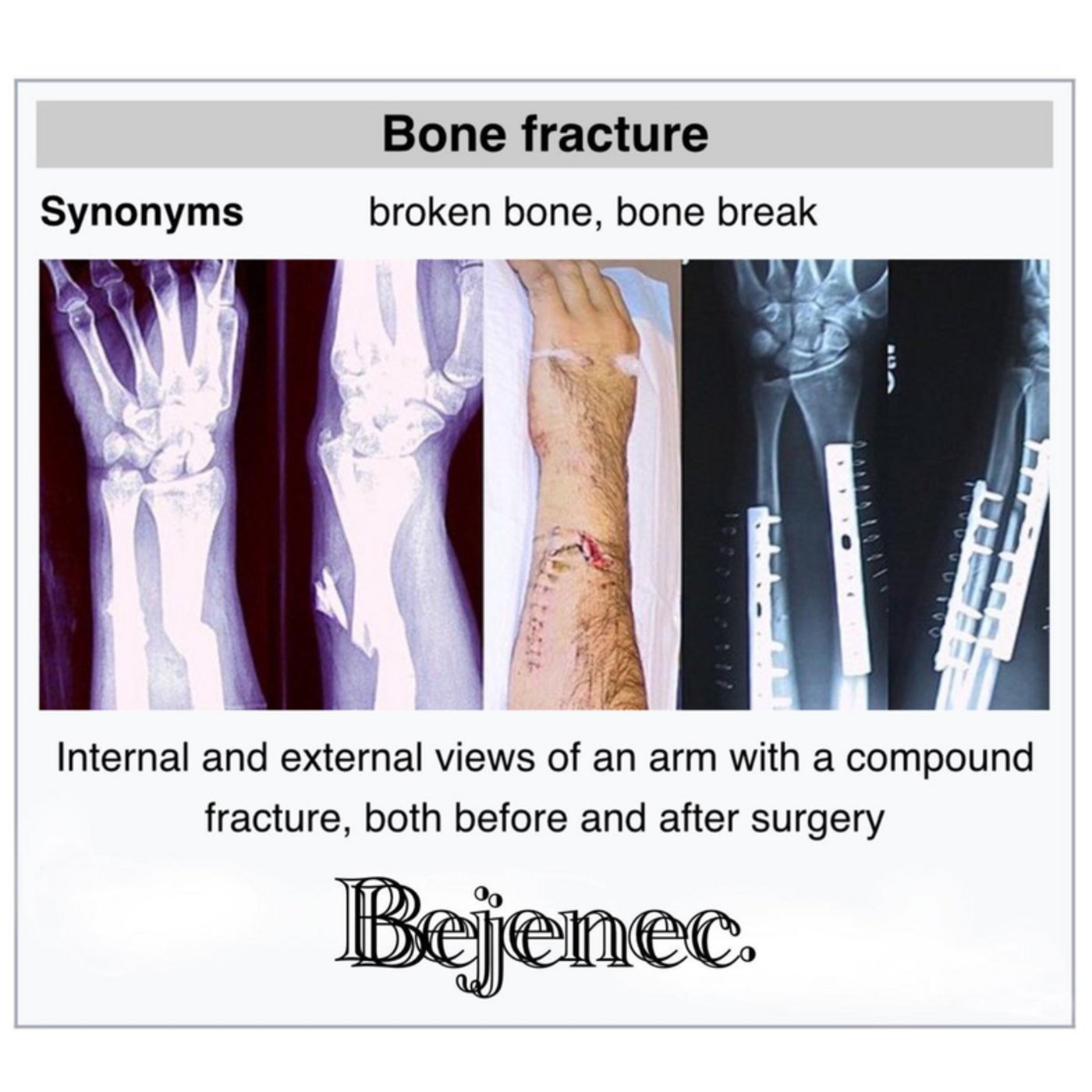 Bone Fracture