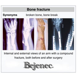 Bone Fracture