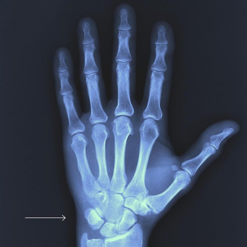 FRACTURE