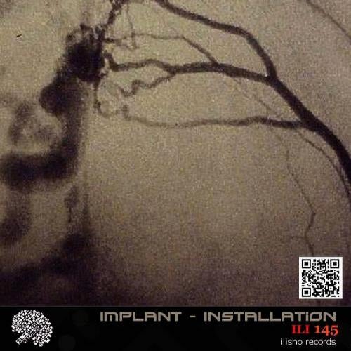 Implant - Installation