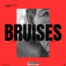 Bruises