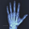FRACTURE