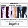 Bone Fracture